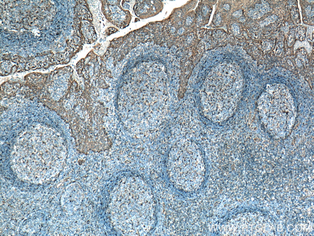 IHC staining of human tonsillitis using 19851-1-AP