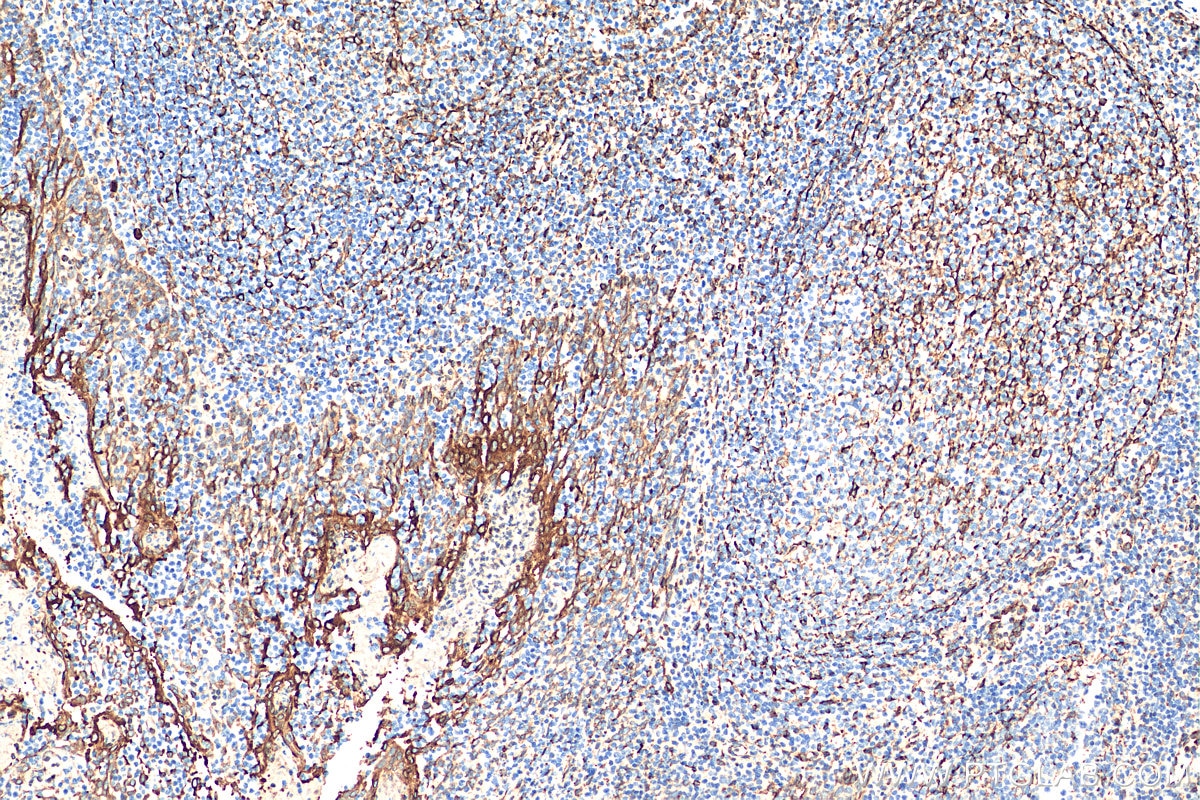 Immunohistochemistry (IHC) staining of human tonsillitis tissue using TMEM173/STING Polyclonal antibody (19851-1-AP)