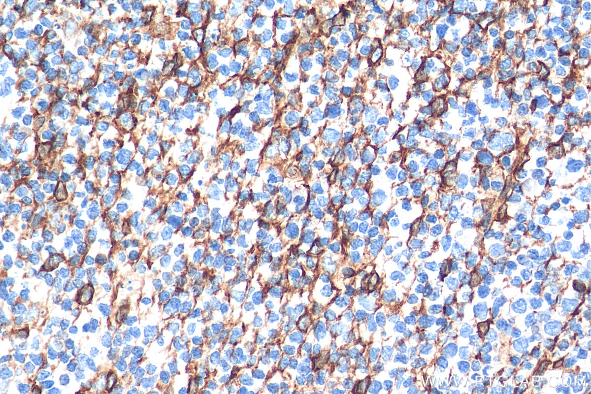 Immunohistochemistry (IHC) staining of human tonsillitis tissue using TMEM173/STING Polyclonal antibody (19851-1-AP)