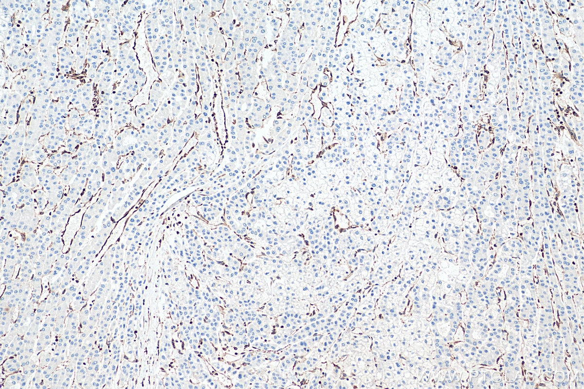 Immunohistochemistry (IHC) staining of human liver cancer tissue using TMEM173/STING Polyclonal antibody (19851-1-AP)