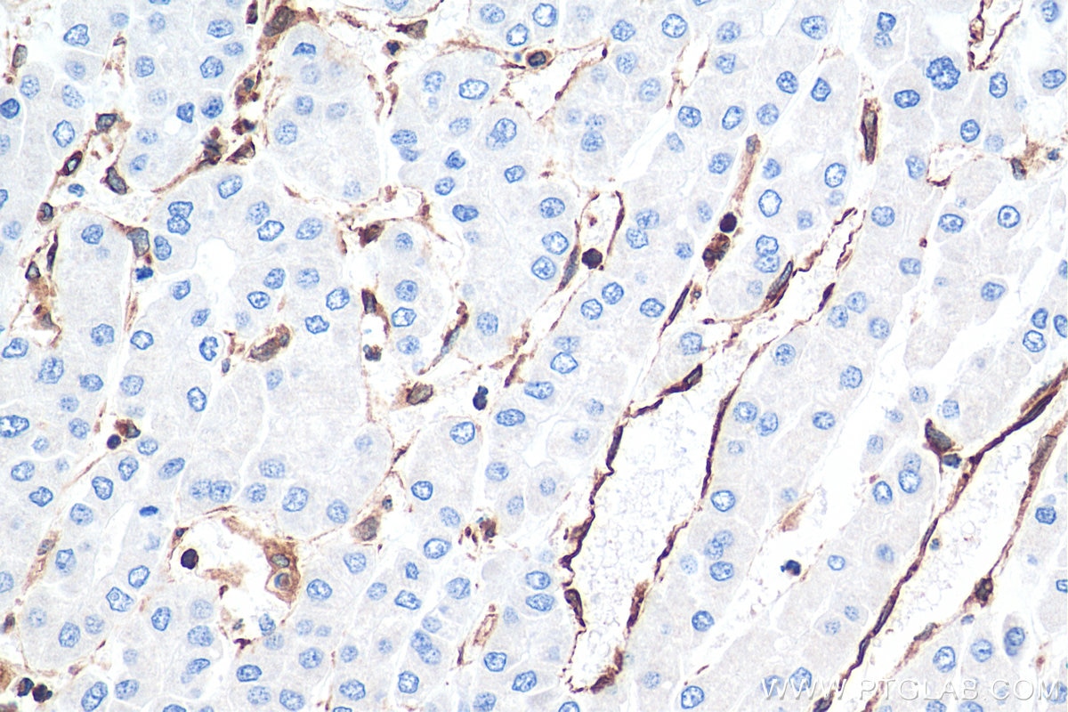 Immunohistochemistry (IHC) staining of human liver cancer tissue using TMEM173/STING Polyclonal antibody (19851-1-AP)