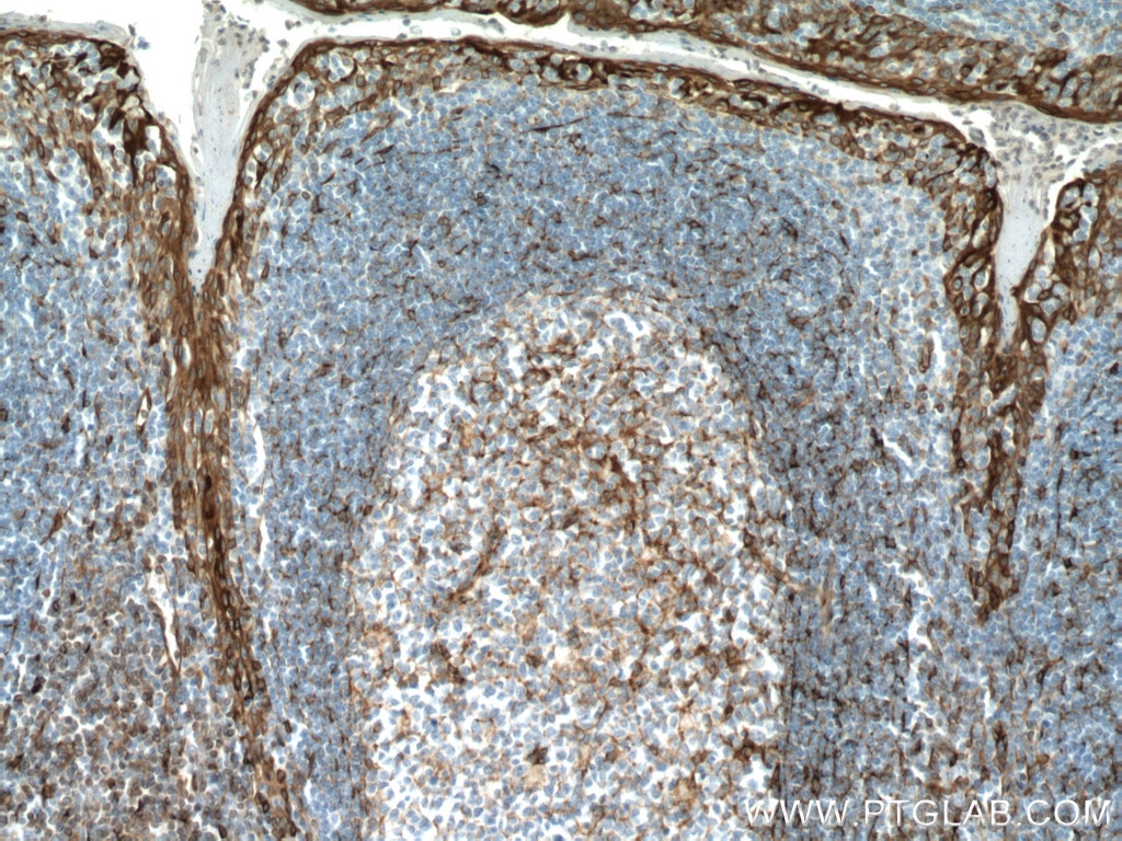Immunohistochemistry (IHC) staining of human tonsillitis tissue using TMEM173/STING Monoclonal antibody (66680-1-Ig)