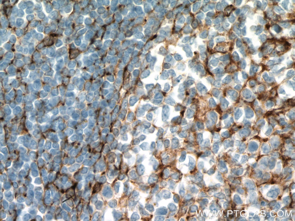 Immunohistochemistry (IHC) staining of human tonsillitis tissue using TMEM173/STING Monoclonal antibody (66680-1-Ig)