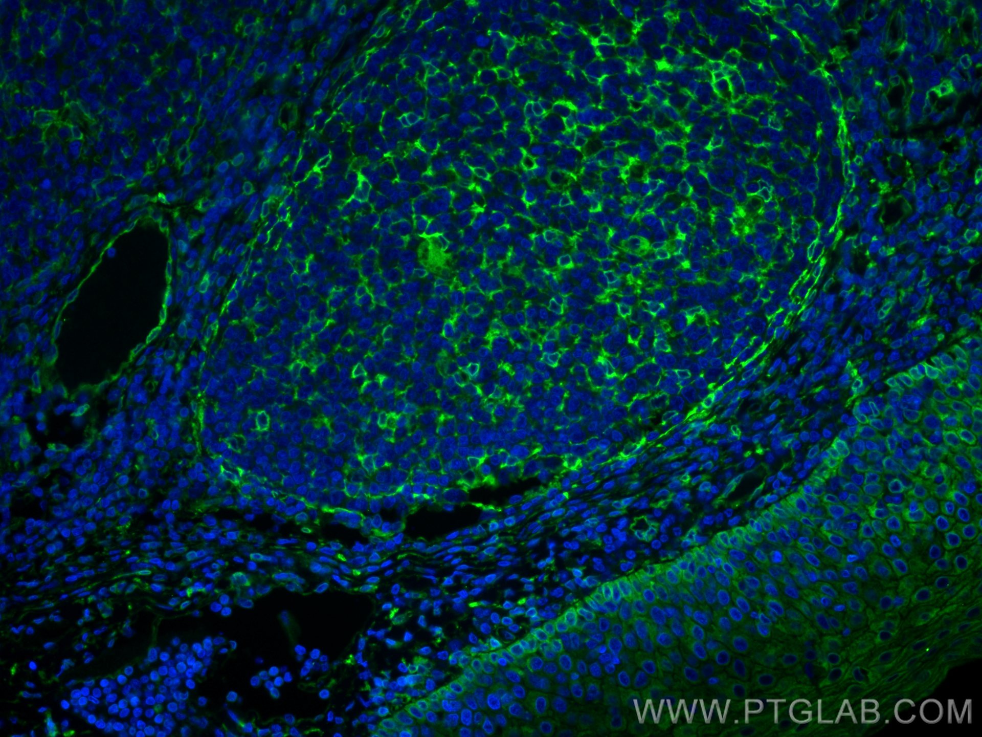 Immunofluorescence (IF) / fluorescent staining of human tonsillitis tissue using TMEM173/STING Recombinant antibody (80165-1-RR)