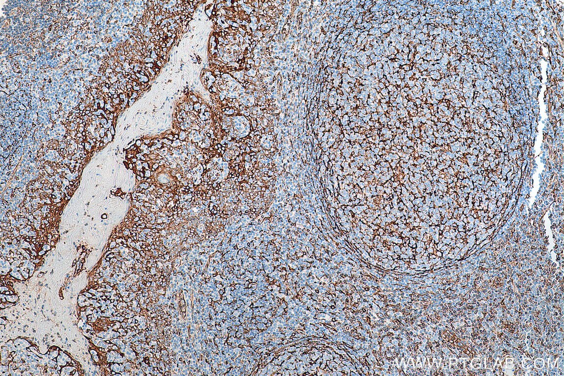 Immunohistochemistry (IHC) staining of human tonsillitis tissue using TMEM173/STING Recombinant antibody (80165-1-RR)