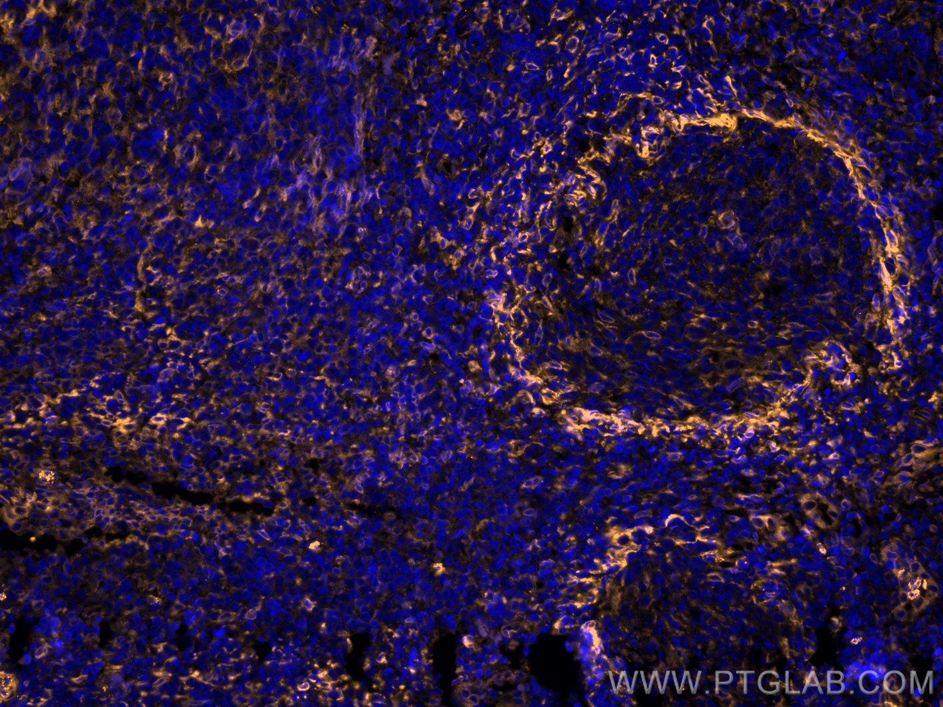 Immunofluorescence (IF) / fluorescent staining of human tonsillitis tissue using CoraLite®555-conjugated TMEM173/STING Recombinant  (CL555-80165)