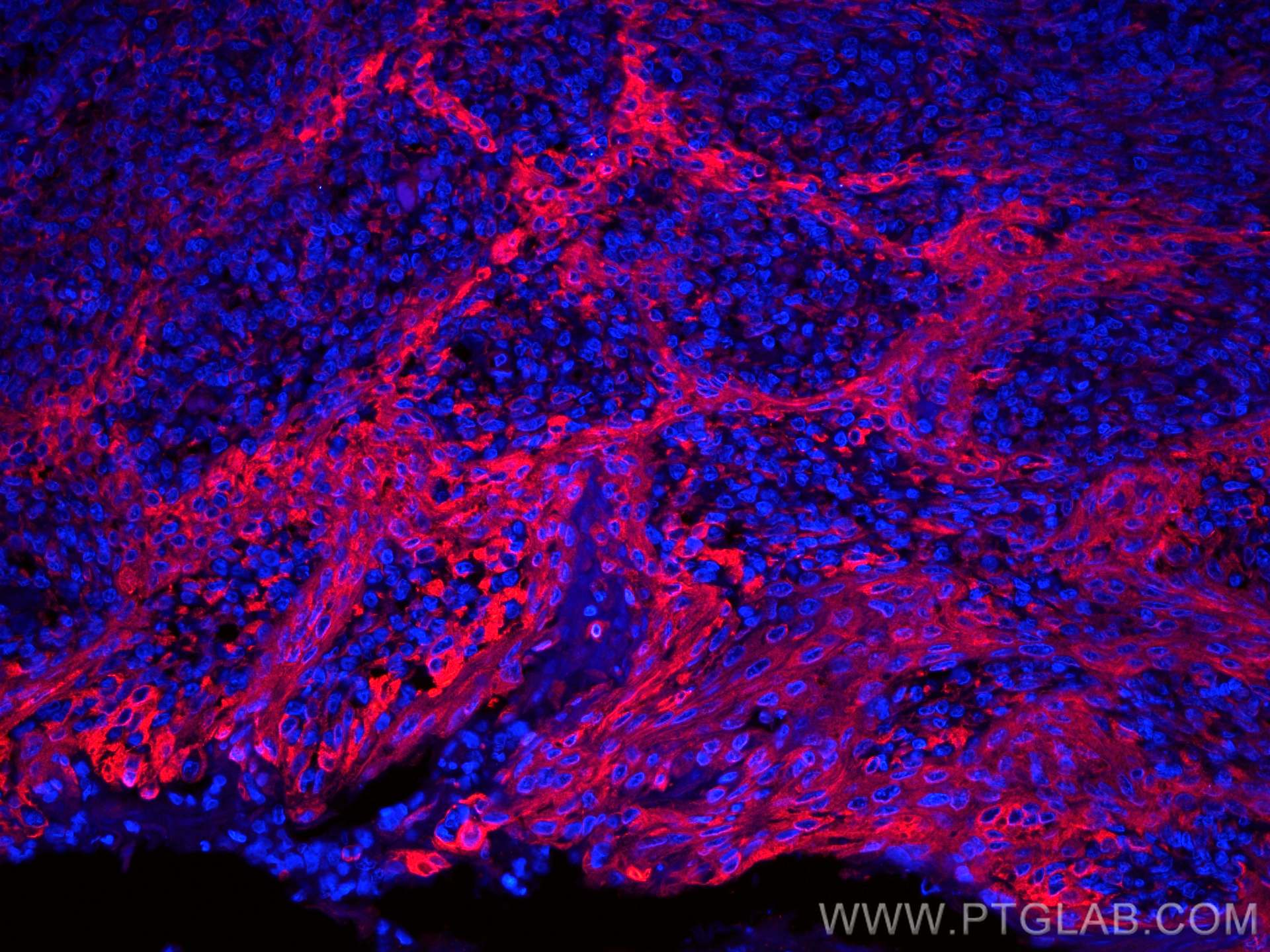 Immunofluorescence (IF) / fluorescent staining of human tonsillitis tissue using CoraLite®594-conjugated TMEM173/STING Polyclonal a (CL594-19851)