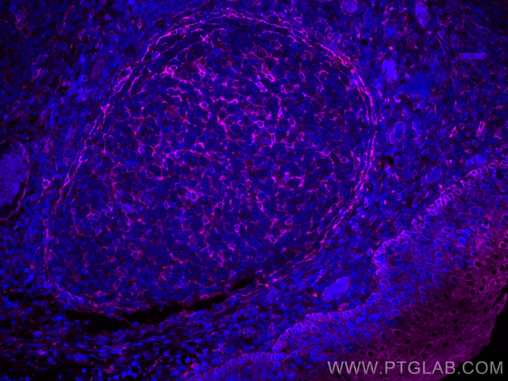 Immunofluorescence (IF) / fluorescent staining of human tonsillitis tissue using CoraLite® Plus 647-conjugated TMEM173/STING Recomb (CL647-80165)