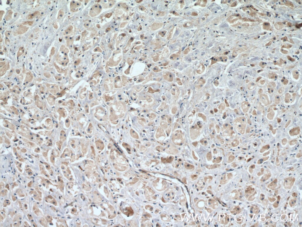 Immunohistochemistry (IHC) staining of human breast cancer tissue using TMEM179 Polyclonal antibody (24799-1-AP)