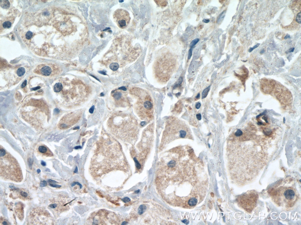 Immunohistochemistry (IHC) staining of human breast cancer tissue using TMEM179 Polyclonal antibody (24799-1-AP)