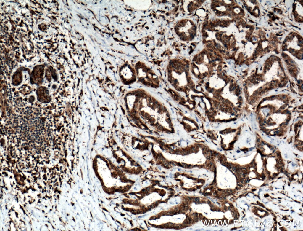 Immunohistochemistry (IHC) staining of human breast cancer tissue using TMEM179 Polyclonal antibody (24799-1-AP)