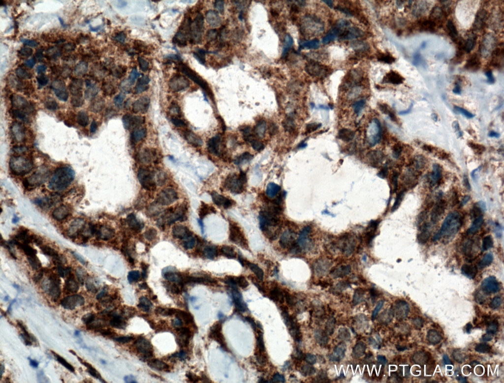 Immunohistochemistry (IHC) staining of human breast cancer tissue using TMEM179 Polyclonal antibody (24799-1-AP)
