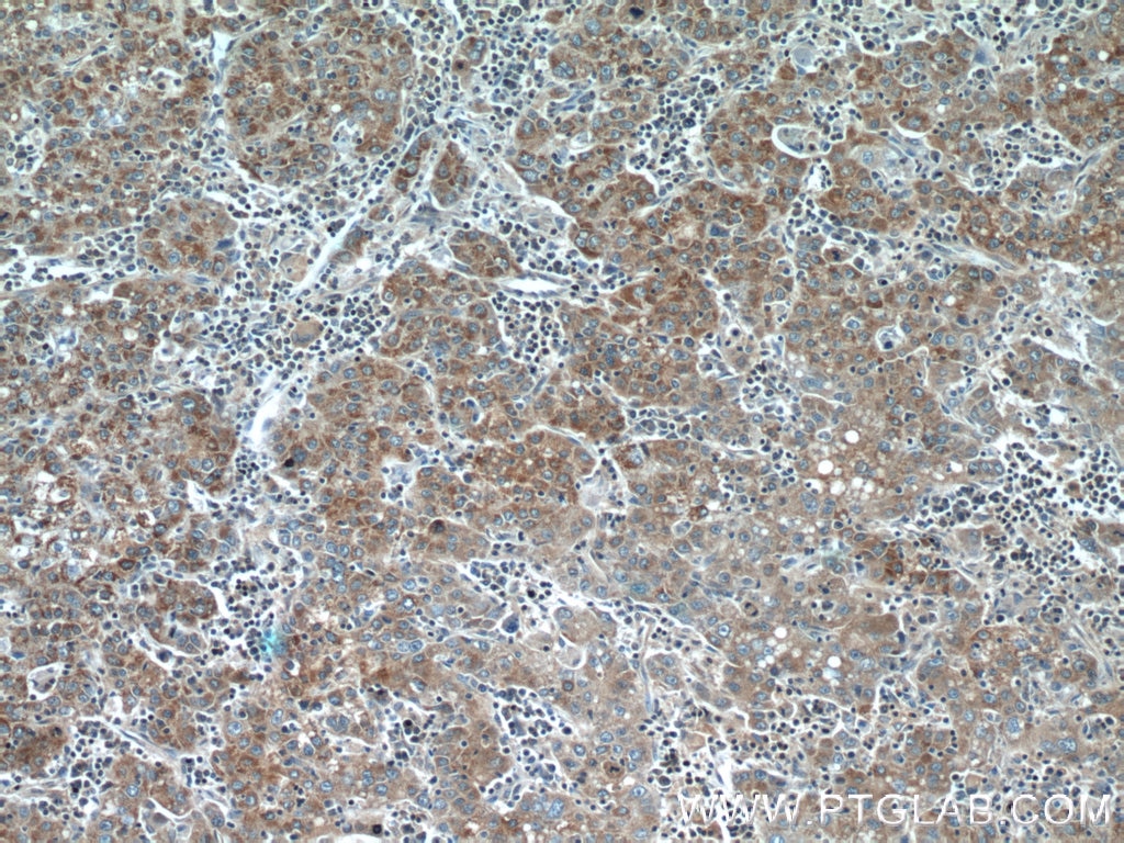 Immunohistochemistry (IHC) staining of human liver cancer tissue using TMEM182 Polyclonal antibody (25366-1-AP)