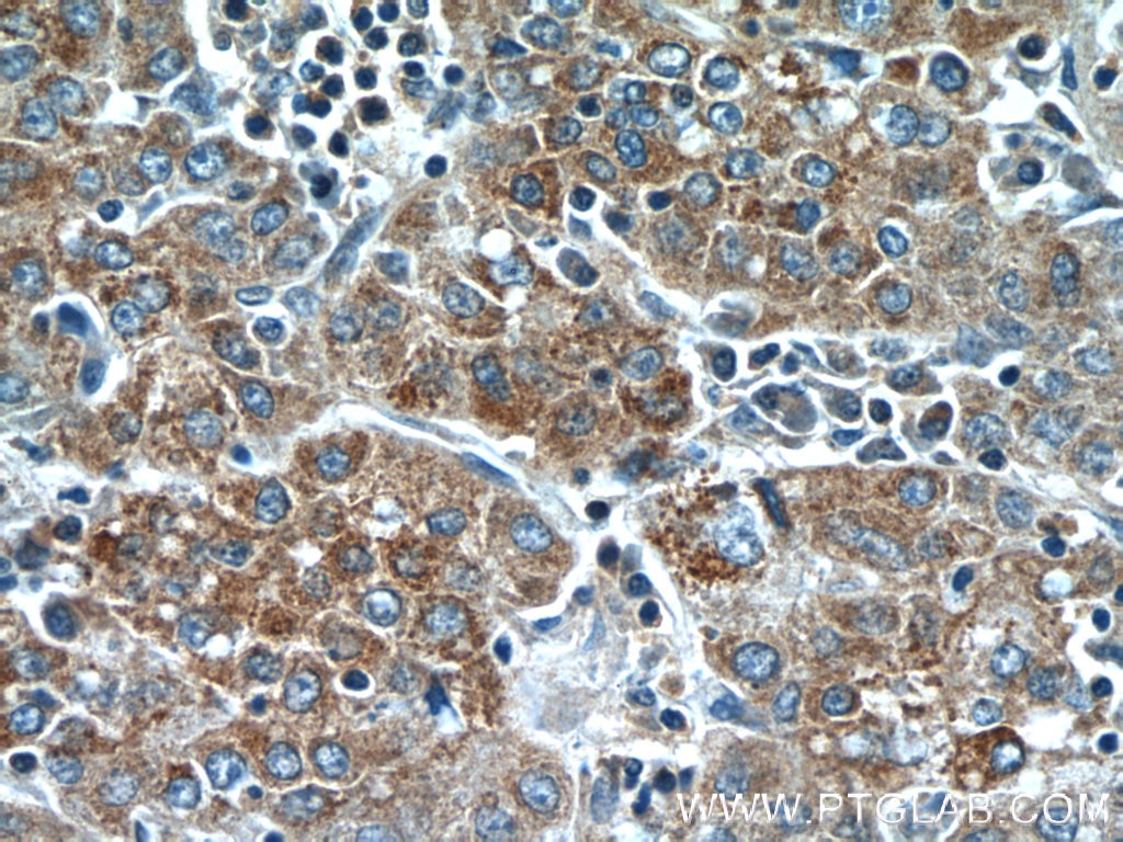Immunohistochemistry (IHC) staining of human liver cancer tissue using TMEM182 Polyclonal antibody (25366-1-AP)