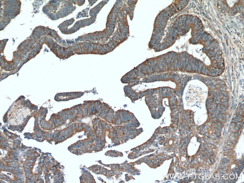 Immunohistochemistry (IHC) staining of human colon cancer tissue using TMEM184A Polyclonal antibody (25989-1-AP)