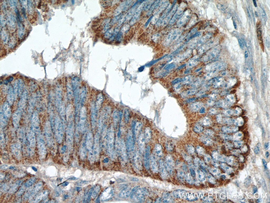 Immunohistochemistry (IHC) staining of human colon cancer tissue using TMEM184A Polyclonal antibody (25989-1-AP)