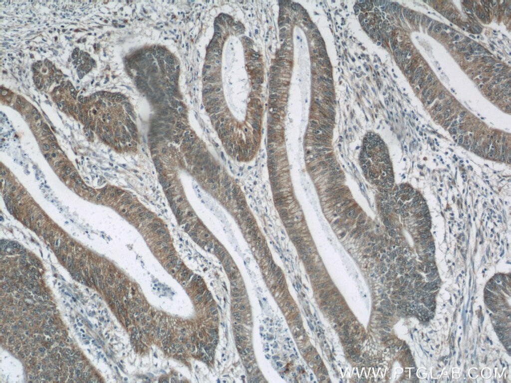 Immunohistochemistry (IHC) staining of human colon cancer tissue using TMEM190 Polyclonal antibody (24904-1-AP)