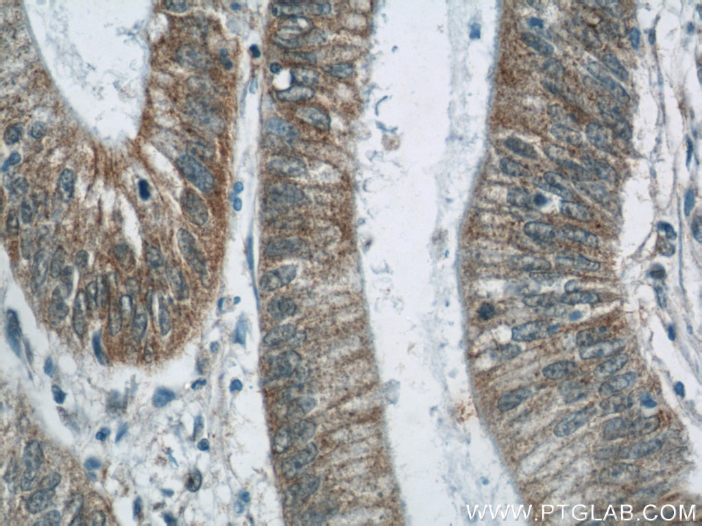 Immunohistochemistry (IHC) staining of human colon cancer tissue using TMEM190 Polyclonal antibody (24904-1-AP)