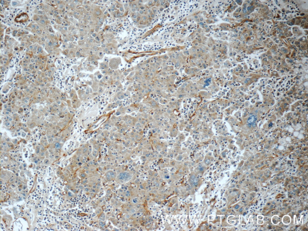 Immunohistochemistry (IHC) staining of human liver cancer tissue using TMEM190 Polyclonal antibody (24904-1-AP)