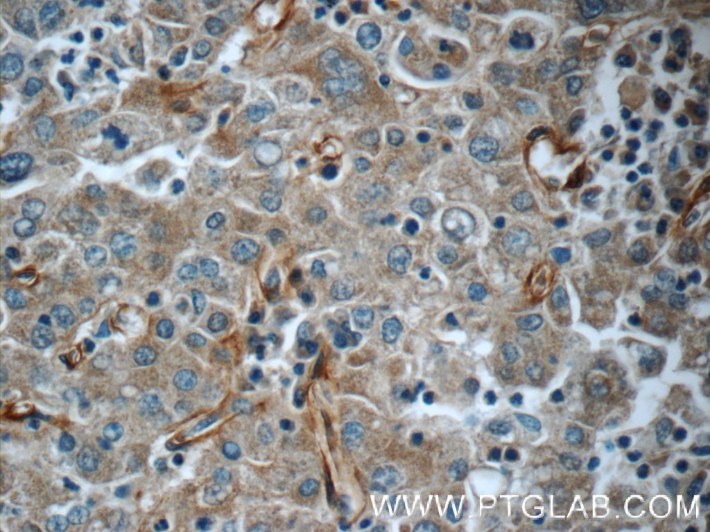 Immunohistochemistry (IHC) staining of human liver cancer tissue using TMEM190 Polyclonal antibody (24904-1-AP)