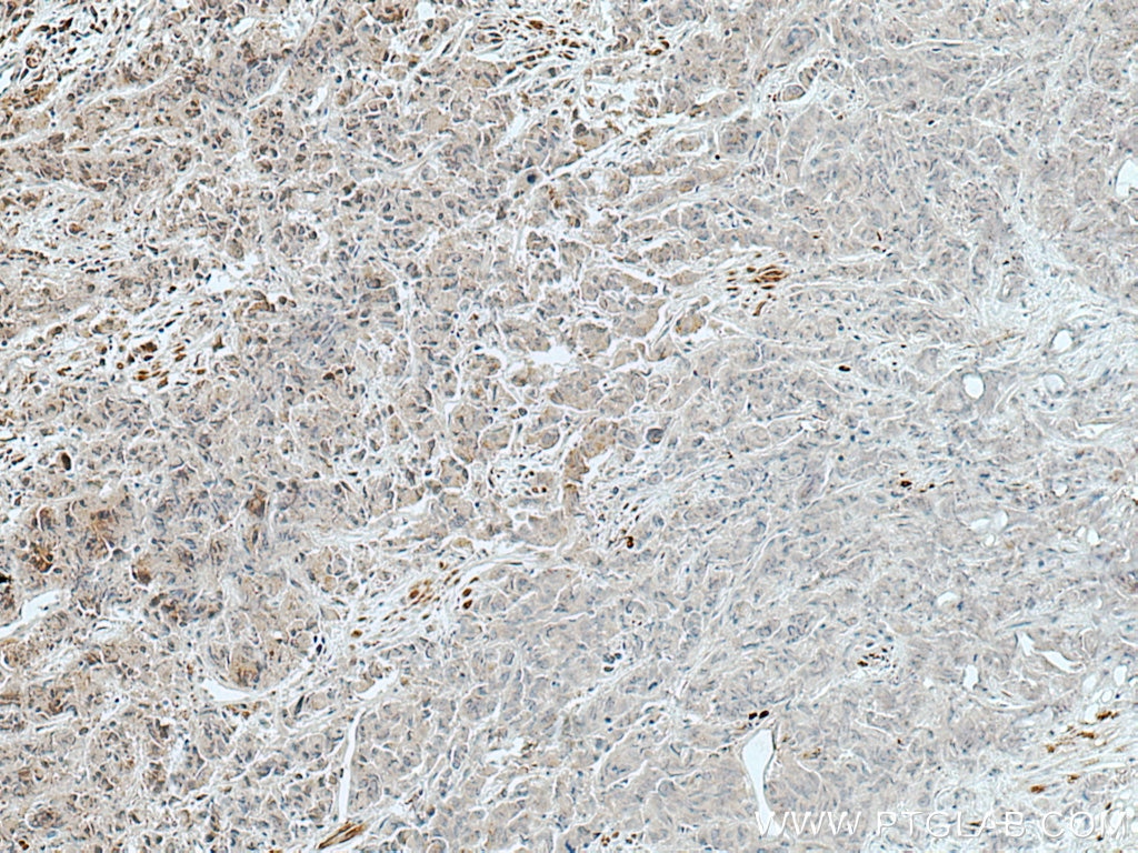 Immunohistochemistry (IHC) staining of human prostate cancer tissue using TMEM192 Polyclonal antibody (28263-1-AP)