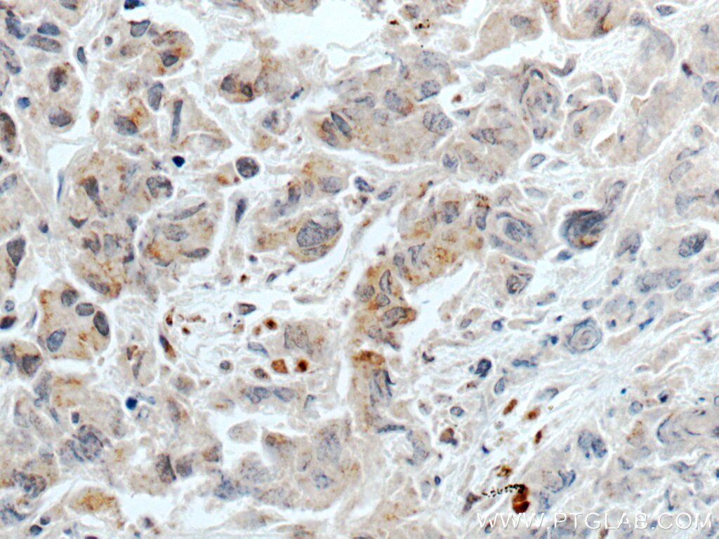 Immunohistochemistry (IHC) staining of human prostate cancer tissue using TMEM192 Polyclonal antibody (28263-1-AP)