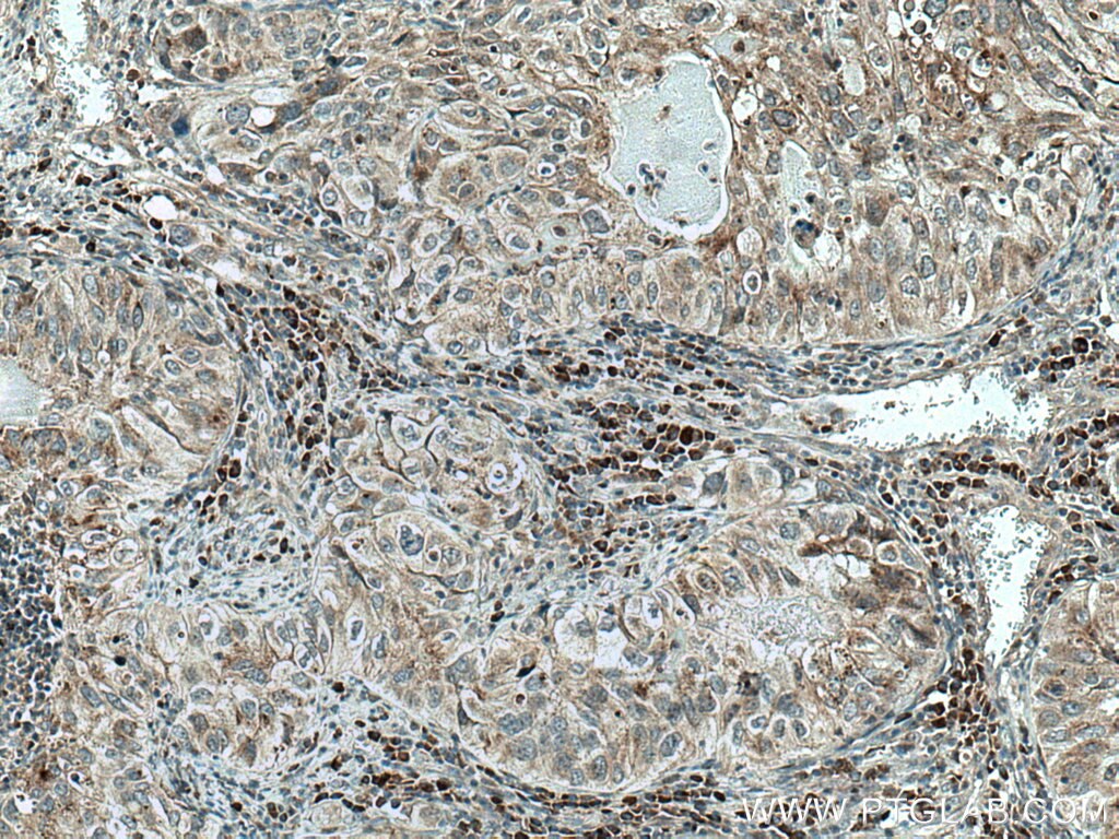 Immunohistochemistry (IHC) staining of human lung cancer tissue using TMEM192 Polyclonal antibody (28263-1-AP)