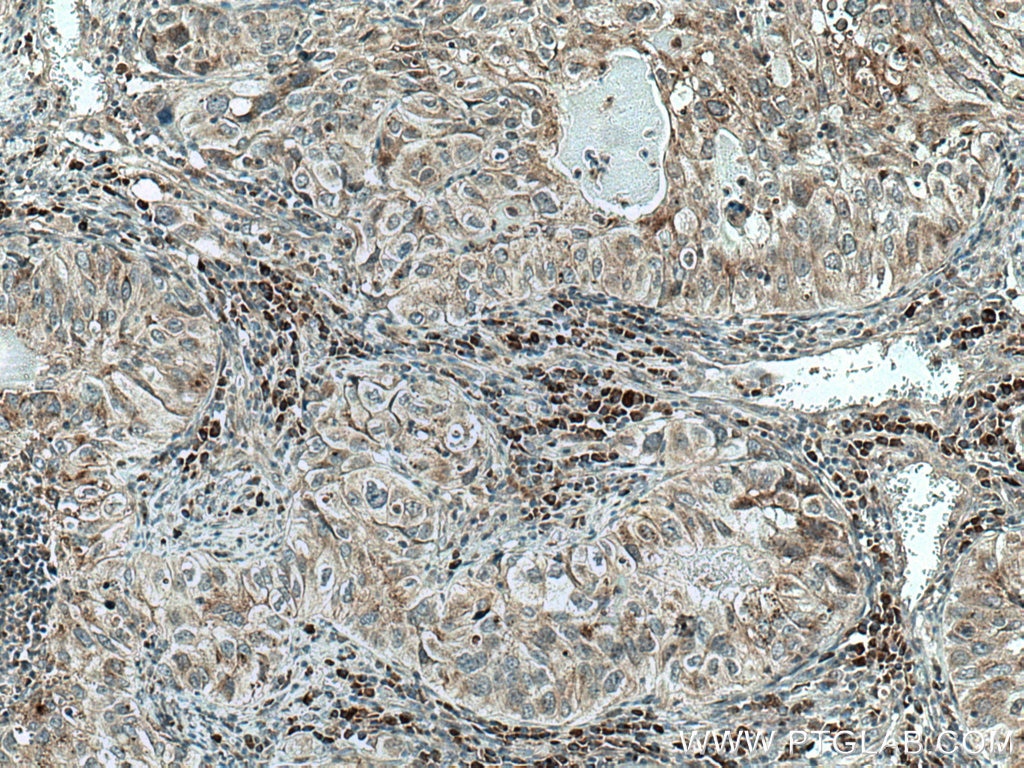 IHC staining of human lung cancer using 28263-1-AP