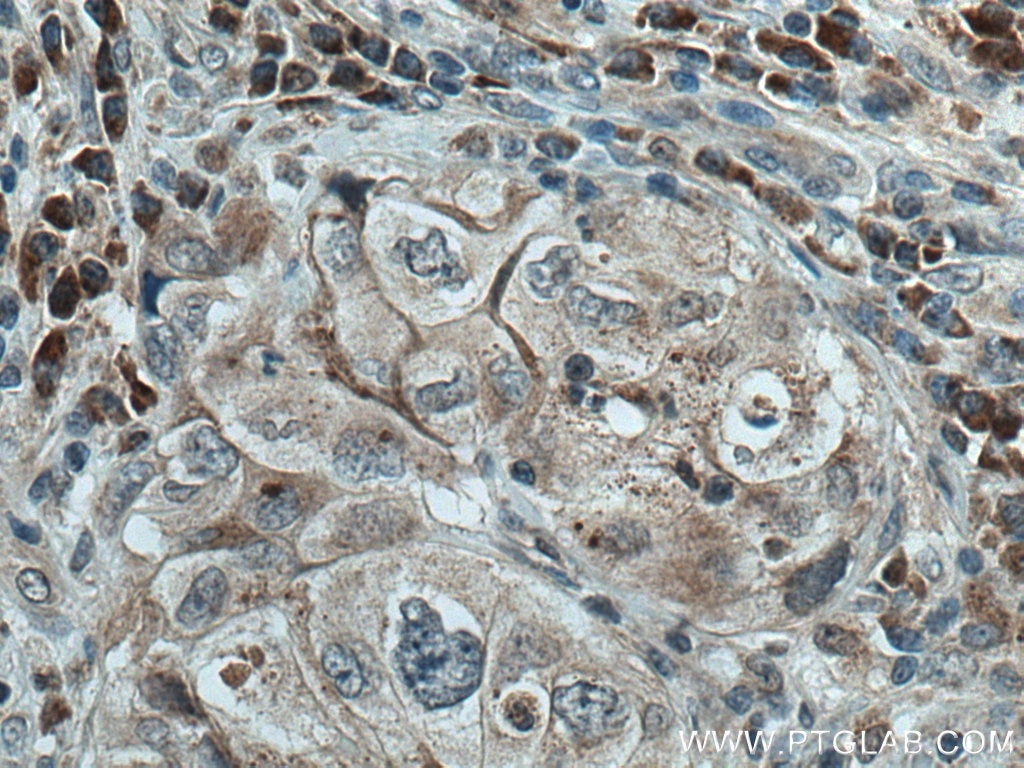 IHC staining of human lung cancer using 28263-1-AP