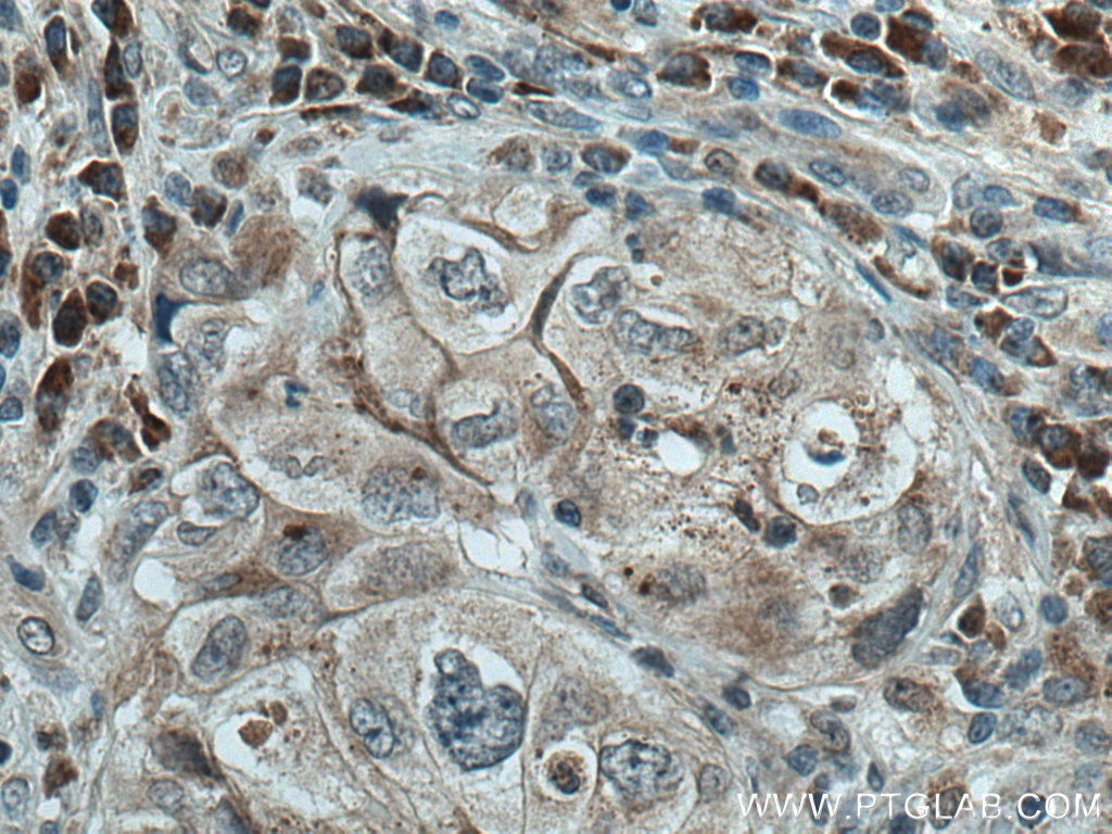 Immunohistochemistry (IHC) staining of human lung cancer tissue using TMEM192 Polyclonal antibody (28263-1-AP)