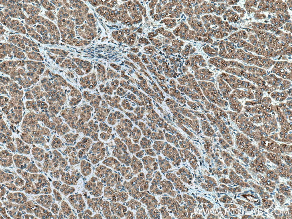 Immunohistochemistry (IHC) staining of human liver cancer tissue using TMEM192 Polyclonal antibody (28263-1-AP)