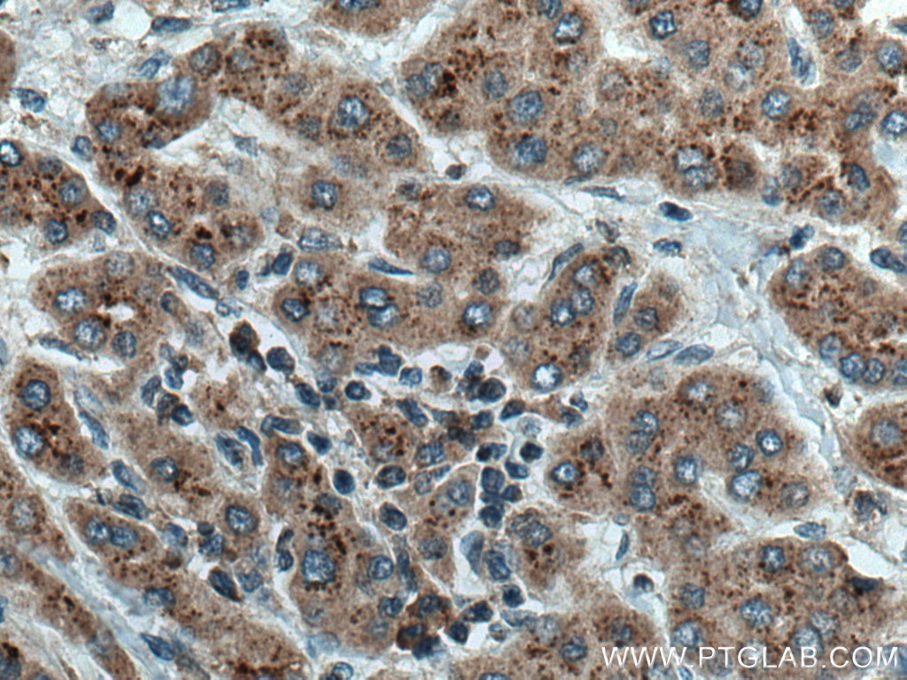 Immunohistochemistry (IHC) staining of human liver cancer tissue using TMEM192 Polyclonal antibody (28263-1-AP)