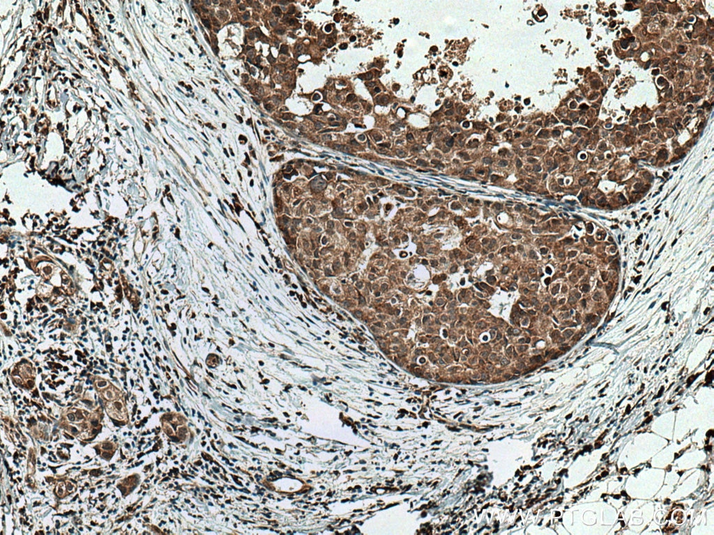 Immunohistochemistry (IHC) staining of human breast cancer tissue using TMEM192 Polyclonal antibody (28263-1-AP)