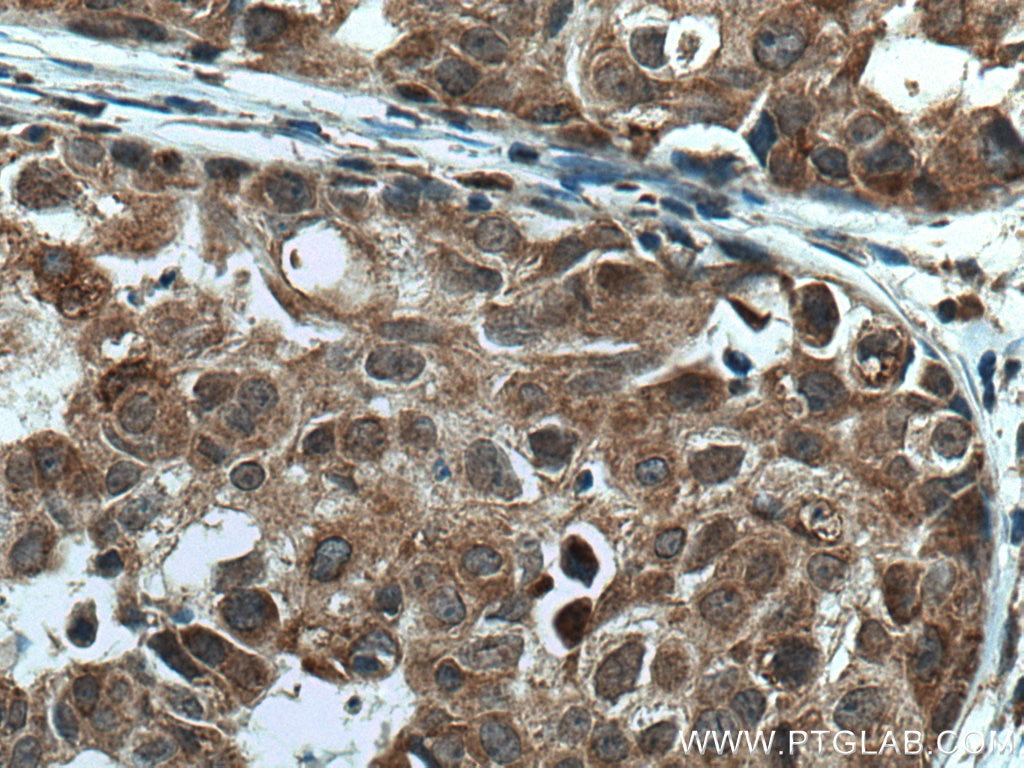 Immunohistochemistry (IHC) staining of human breast cancer tissue using TMEM192 Polyclonal antibody (28263-1-AP)