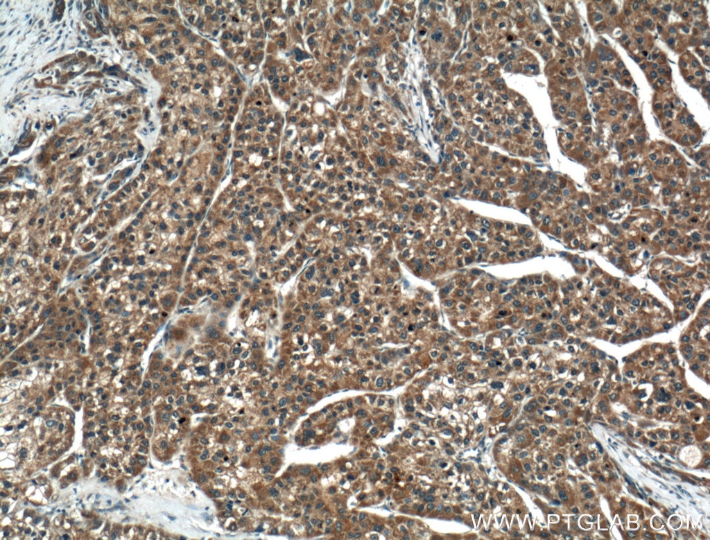 Immunohistochemistry (IHC) staining of human liver cancer tissue using TMEM195 Polyclonal antibody (21355-1-AP)