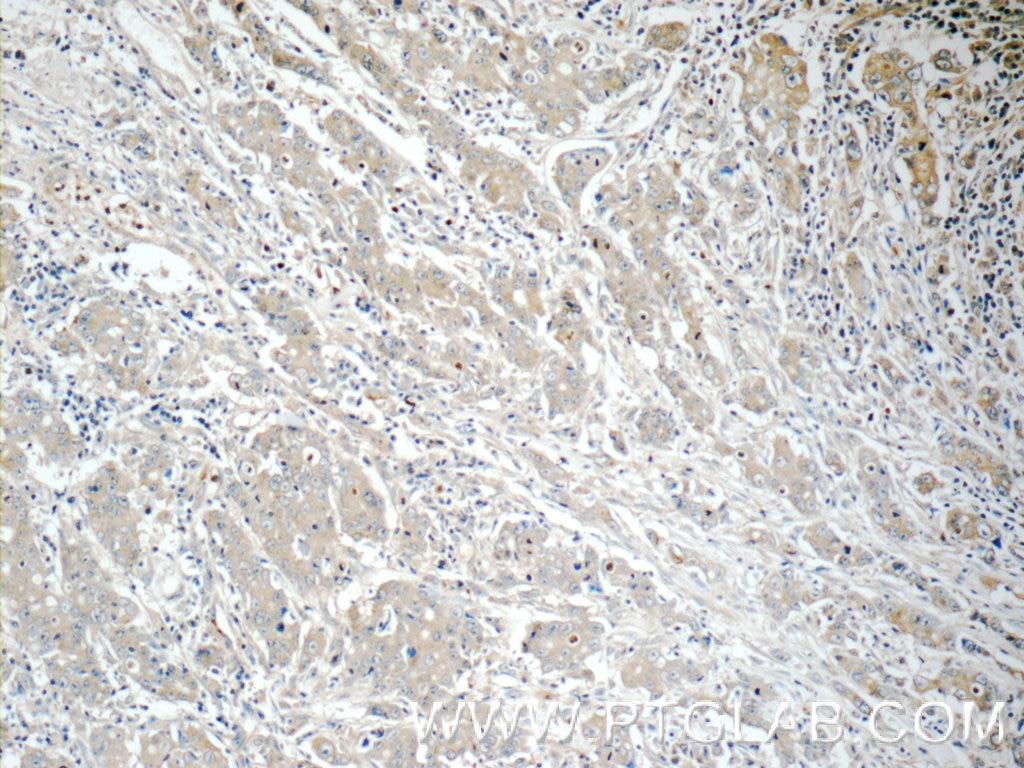 Immunohistochemistry (IHC) staining of human stomach cancer tissue using TMEM199 Polyclonal antibody (25489-1-AP)