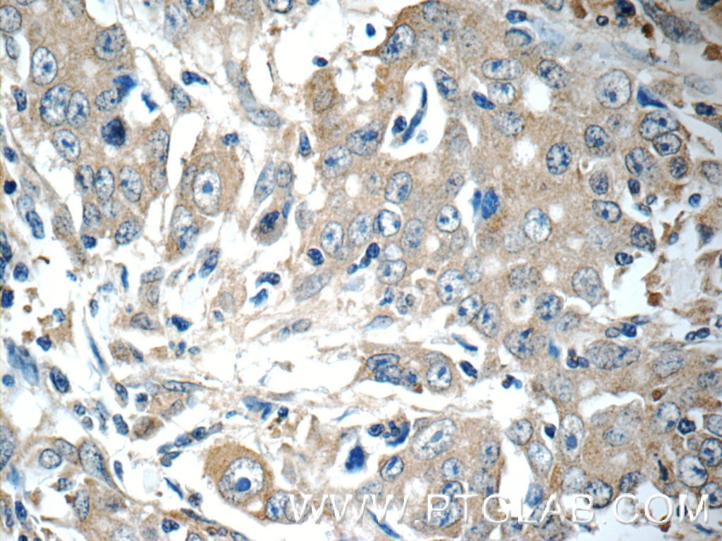 Immunohistochemistry (IHC) staining of human stomach cancer tissue using TMEM199 Polyclonal antibody (25489-1-AP)