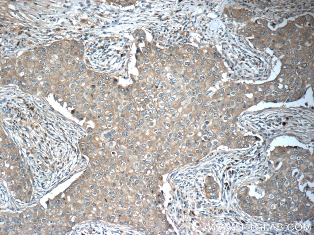 Immunohistochemistry (IHC) staining of human breast cancer tissue using TMEM199 Polyclonal antibody (25489-1-AP)