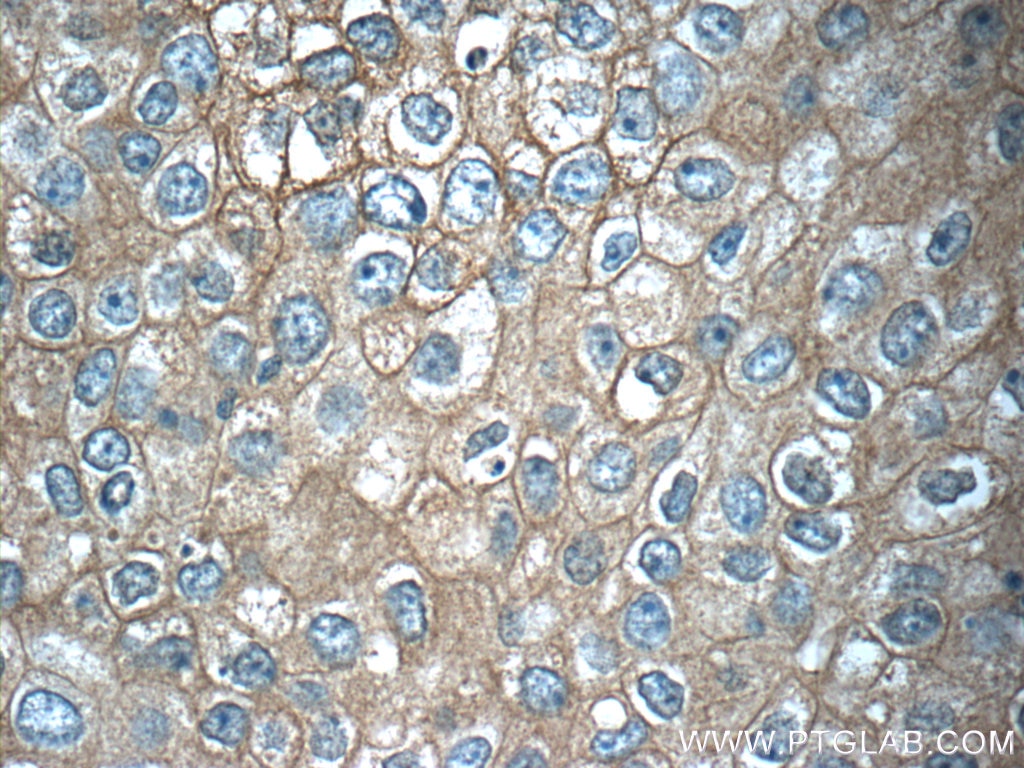 Immunohistochemistry (IHC) staining of human breast cancer tissue using TMEM199 Polyclonal antibody (25489-1-AP)