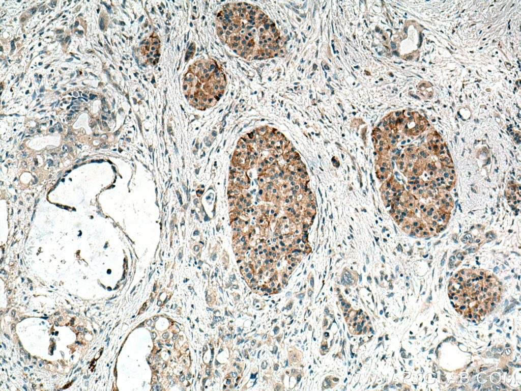 Immunohistochemistry (IHC) staining of human pancreas cancer tissue using TMEM24 Polyclonal antibody (25507-1-AP)