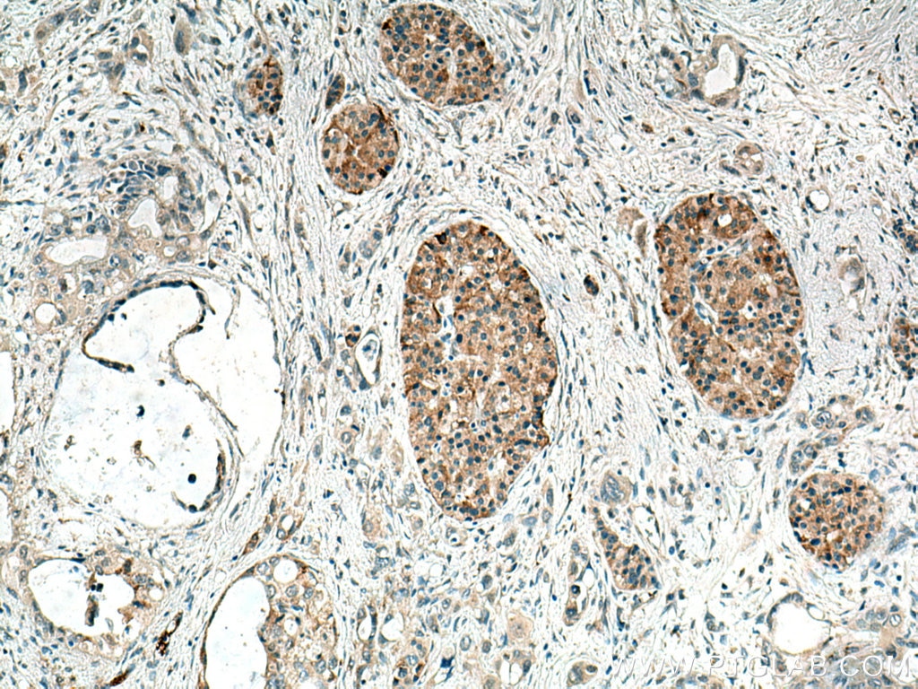 IHC staining of human pancreas cancer using 25507-1-AP