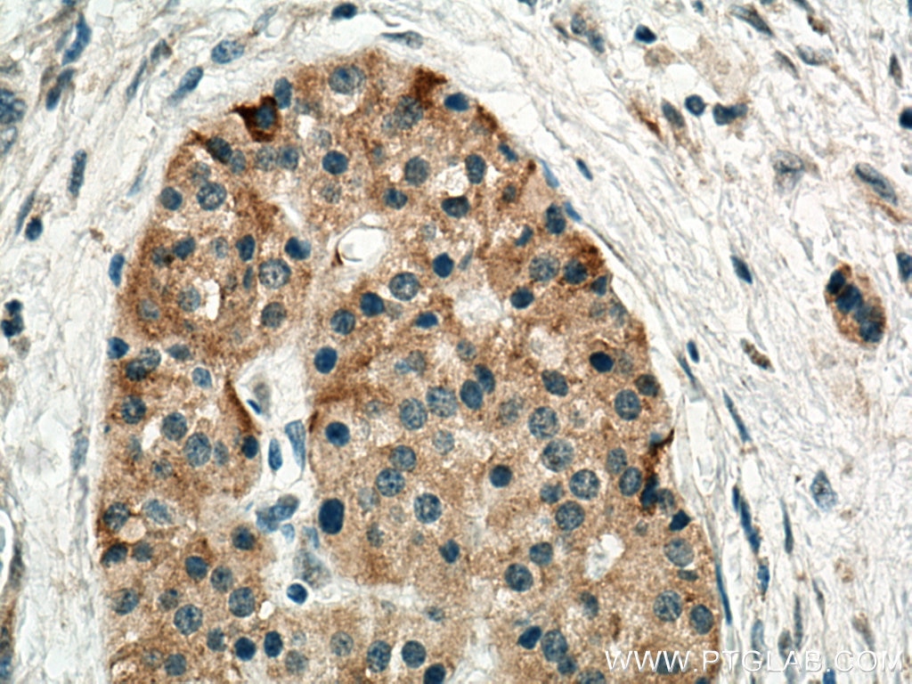 Immunohistochemistry (IHC) staining of human pancreas cancer tissue using TMEM24 Polyclonal antibody (25507-1-AP)