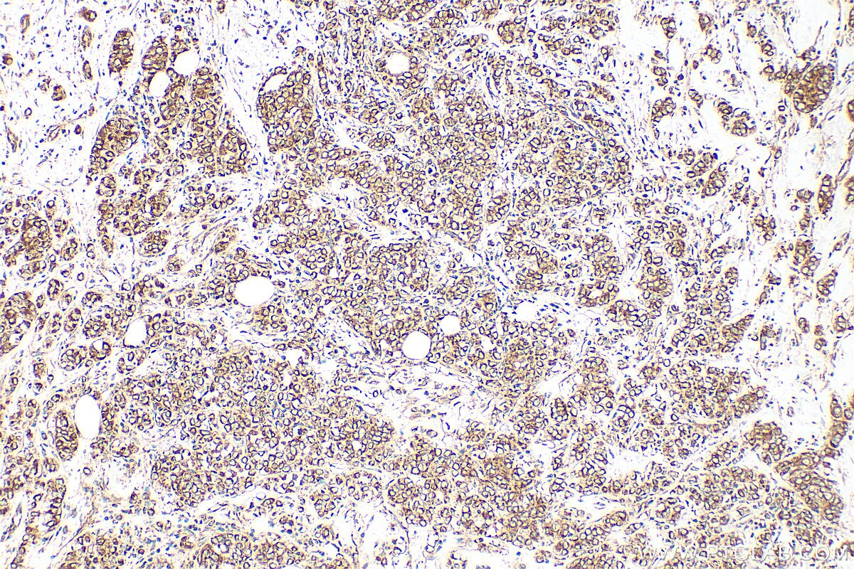 IHC staining of human breast cancer using 27267-1-AP Immunohistochemistry (IHC) staining of human breast cancer tissue using TMEM26 Polyclonal antibody (27267-1-AP)