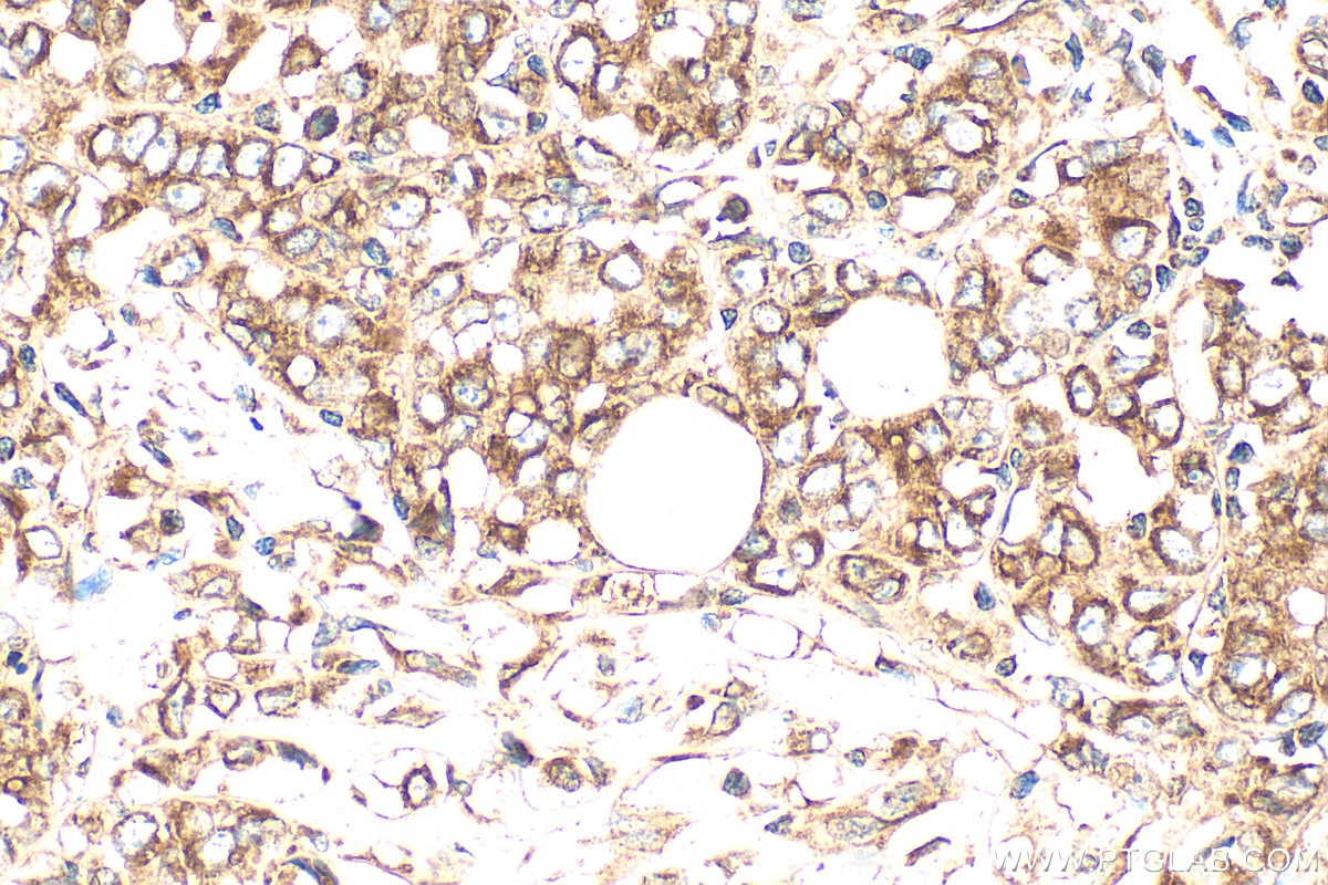 IHC staining of human breast cancer using 27267-1-AP Immunohistochemistry (IHC) staining of human breast cancer tissue using TMEM26 Polyclonal antibody (27267-1-AP)