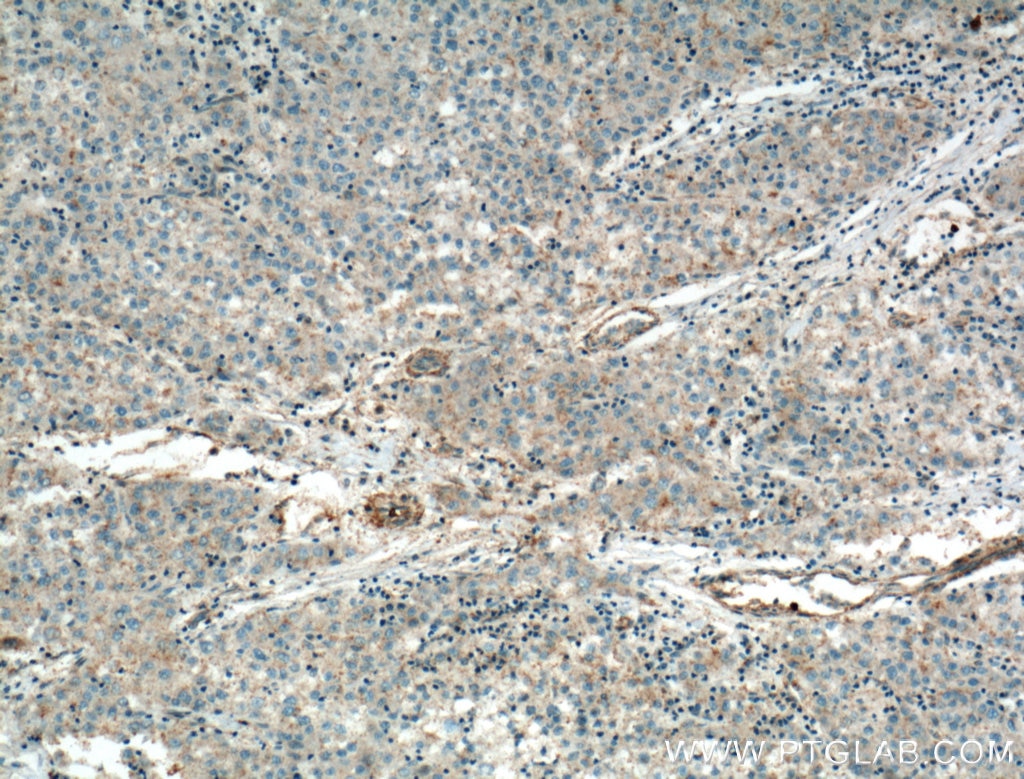 Immunohistochemistry (IHC) staining of human liver cancer tissue using TMEM27 Polyclonal antibody (19207-1-AP)