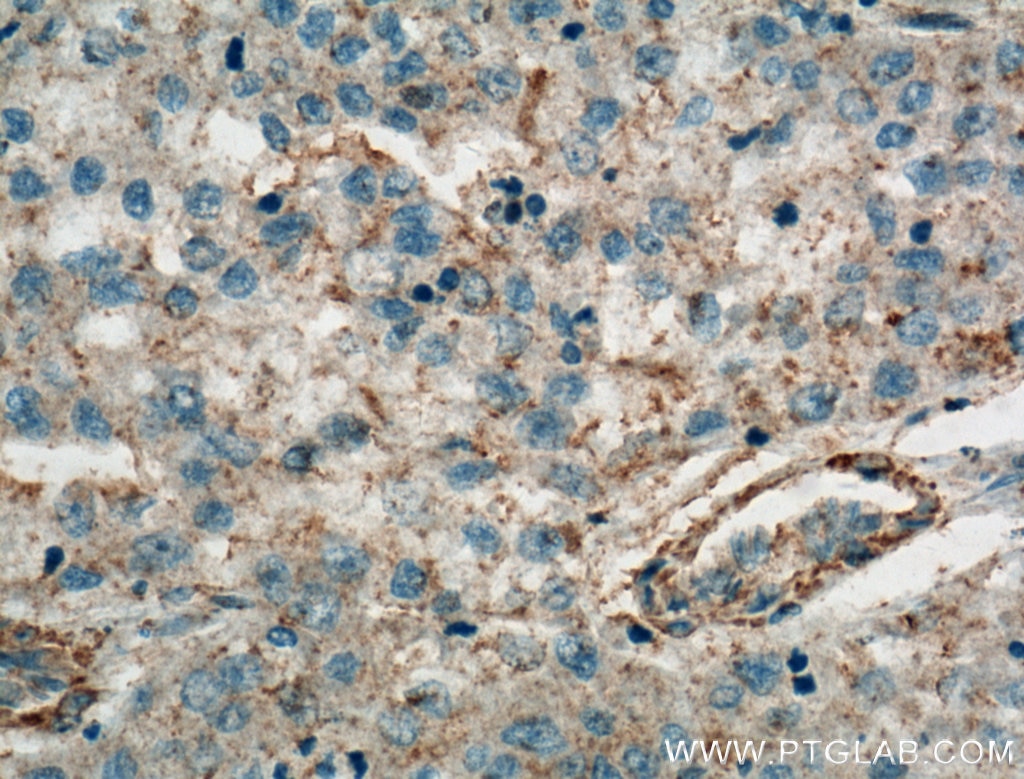 Immunohistochemistry (IHC) staining of human liver cancer tissue using TMEM27 Polyclonal antibody (19207-1-AP)