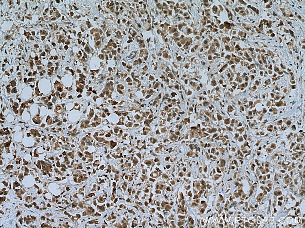 Immunohistochemistry (IHC) staining of human breast cancer tissue using TMEM39A Polyclonal antibody (20430-1-AP)