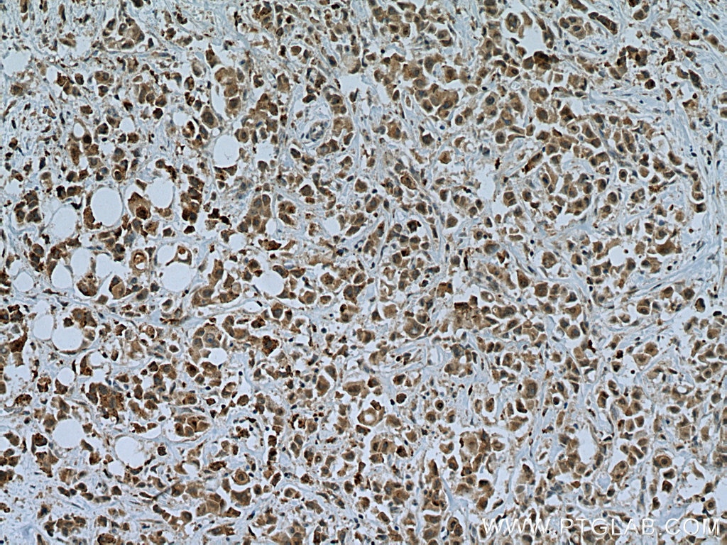 Immunohistochemistry (IHC) staining of human breast cancer tissue using TMEM39A Polyclonal antibody (20430-1-AP)