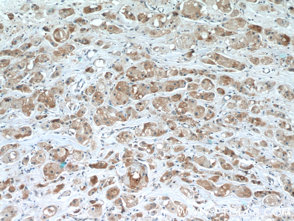 Immunohistochemistry (IHC) staining of human breast cancer tissue using TMEM59 Polyclonal antibody (24134-1-AP)