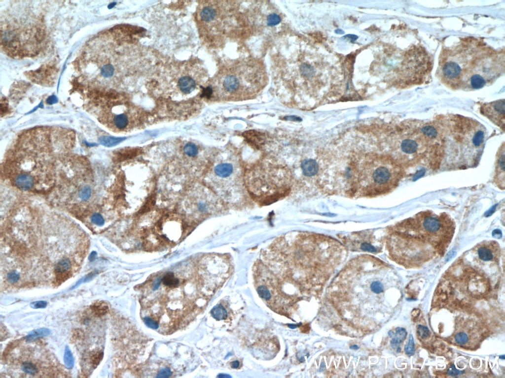 Immunohistochemistry (IHC) staining of human breast cancer tissue using TMEM59 Polyclonal antibody (24134-1-AP)